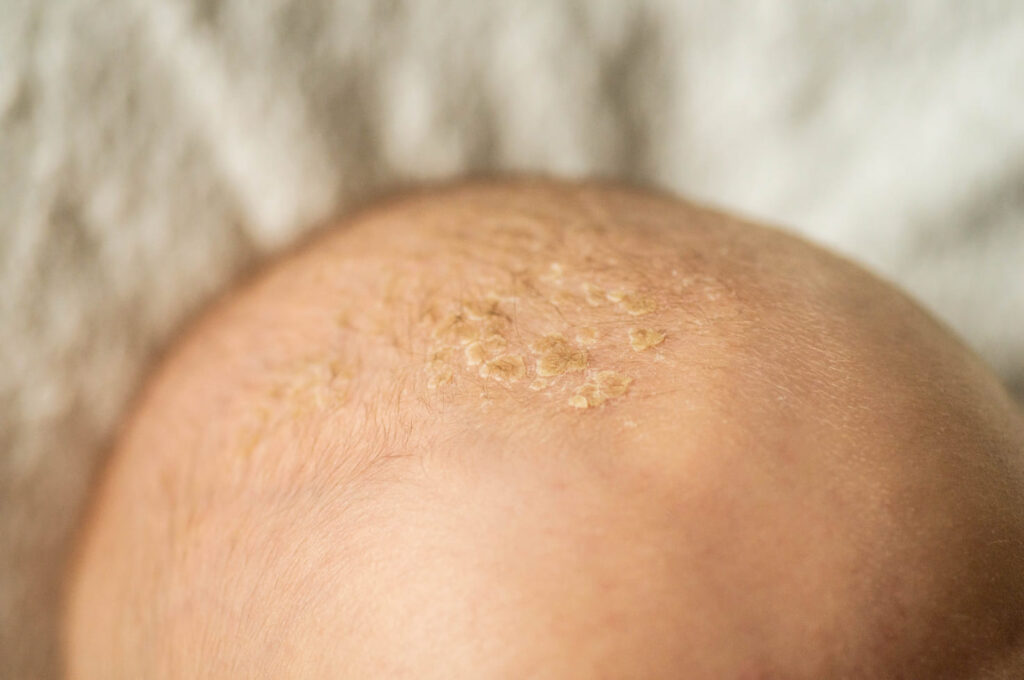 Dermatitis seborreica y caída de pelo