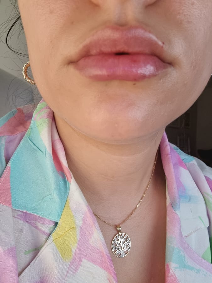 aumento de labios con acido hialurónico 
