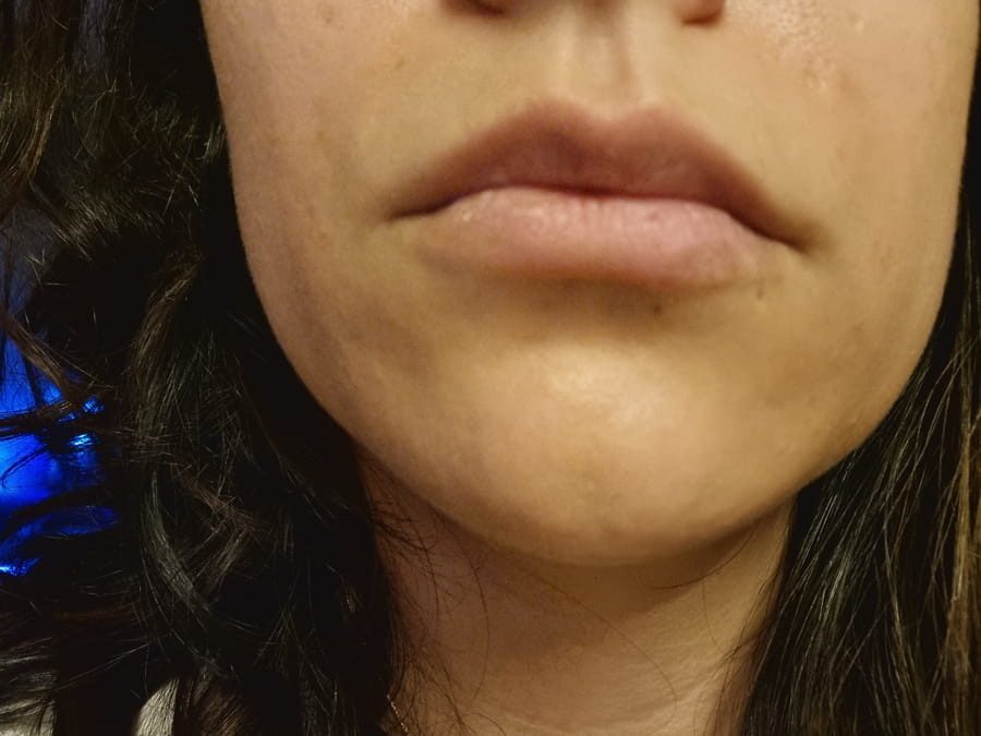 aumento de labios con acido hialurónico antes y después