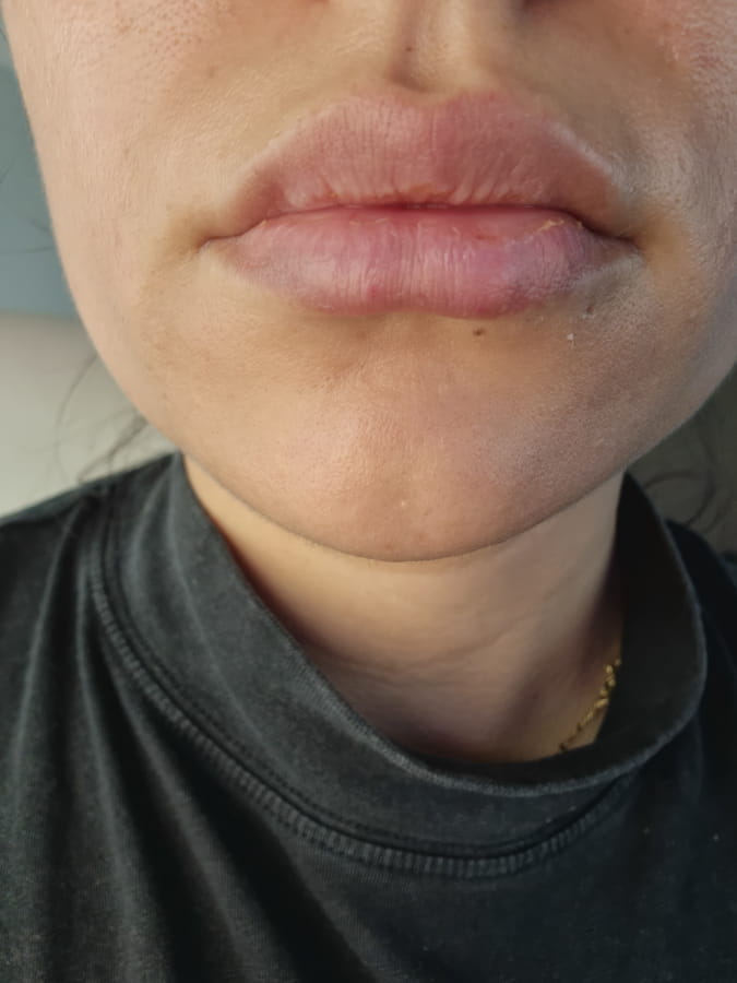 Aumento de labios sin cirugía